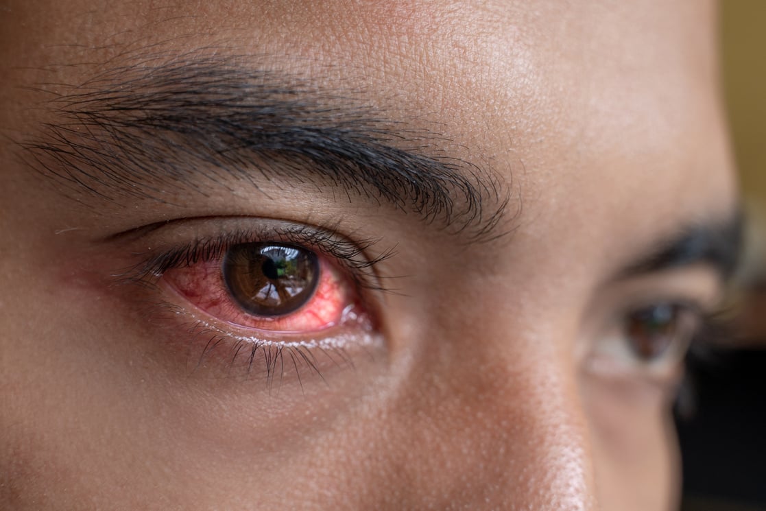 Irritated Red Eyes Need Sterile Eye Drops